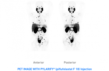 新药|Pylarify(Piflufolastat F18)显像剂美国获批识别前列腺癌的疑似转移或复发