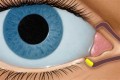 免费治疗|IVIEW-1201滴眼液治疗急性腺病毒性结膜炎(红眼病)临床试验