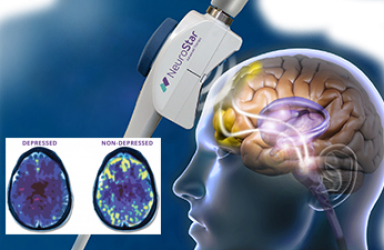 首款|NeuroStar(TMS)经颅磁刺激美国获批辅助治疗15-21岁青少年的抑郁症