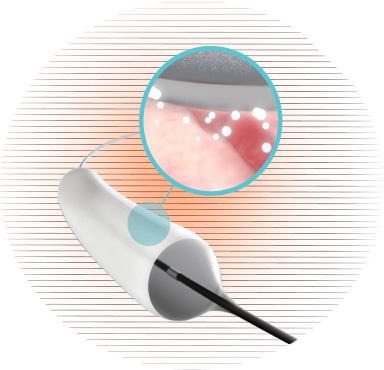 新药|optilume紫杉醇涂层球囊美国获批治疗尿道狭窄